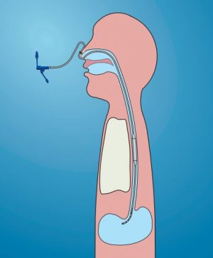 Dynamic stent