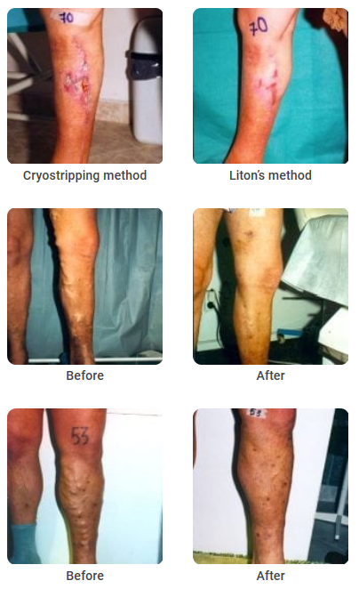 lipitori medicale de la varicoza exerciiul complex în piciorul varicos