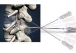 CRYO-S ELECTRIC CryoSurgery System