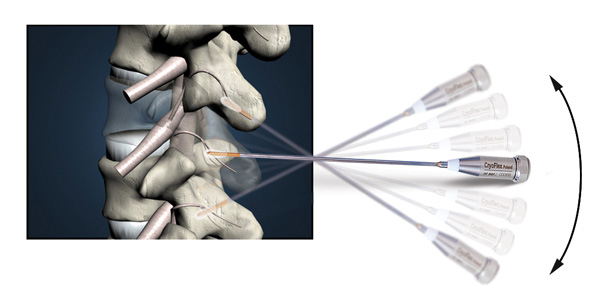 CRYO-S ELECTRIC CryoSurgery System