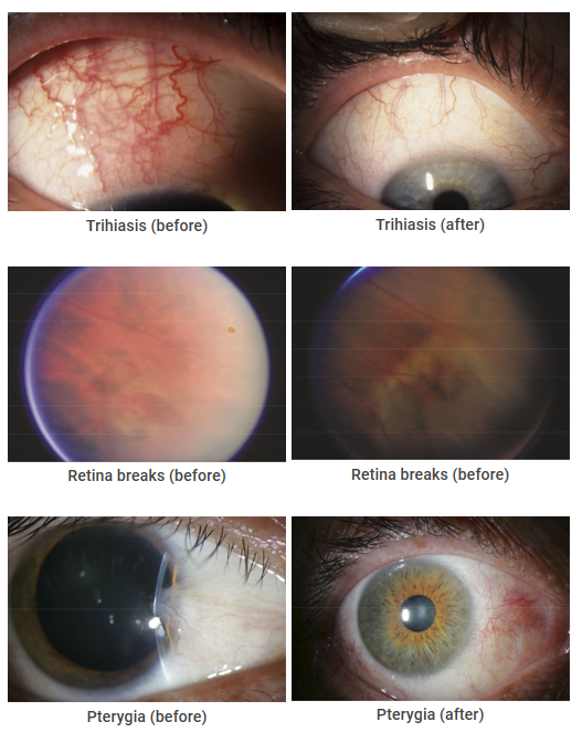 OPHTHALMOLOGY – CRYO-S Electric
