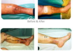 PHLEBOLOGY – CRYO-S Electric