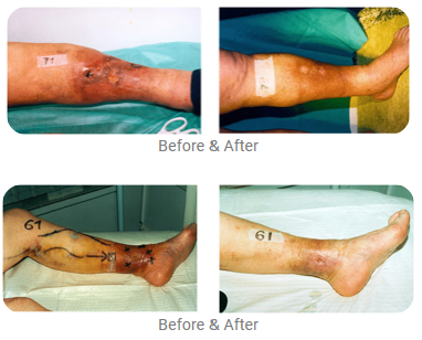 PHLEBOLOGY – CRYO-S Electric