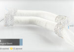 EGIS Oesophageal Stent