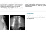 EGIS Oesophageal Stent