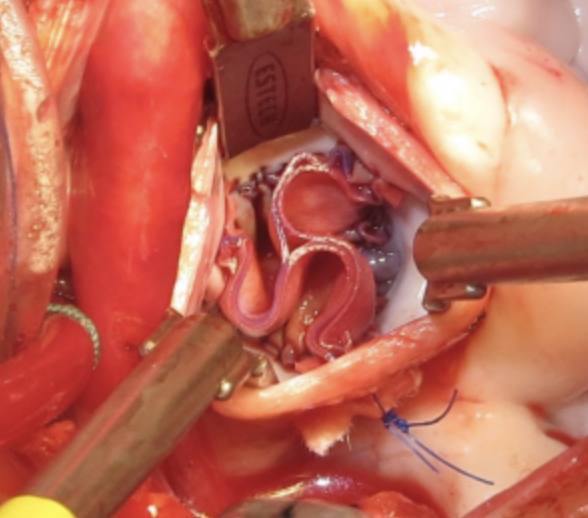 AVNeo™ Sizer System