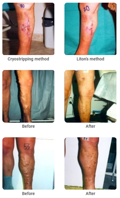 PHLEBOLOGY – CRYO-S Electric | BVM Medical